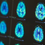 What Kind of Brain Scans for Diagnosing Dementia Are There?