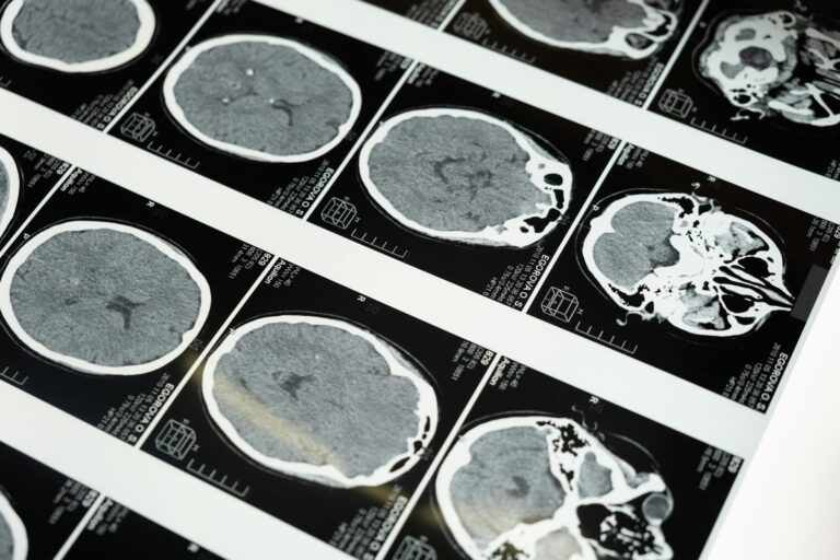 What does brain atrophy look like on an mri scan - Featured image