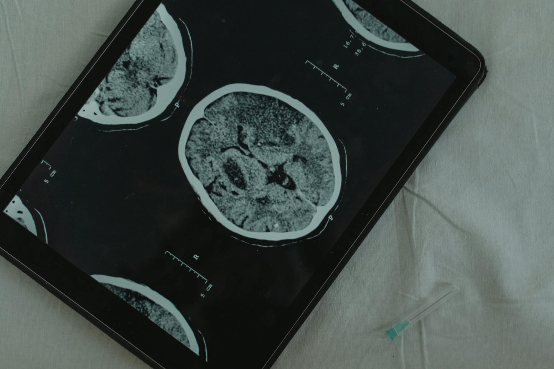 Blood Tests Compared to Brain Imaging and CSF Testing