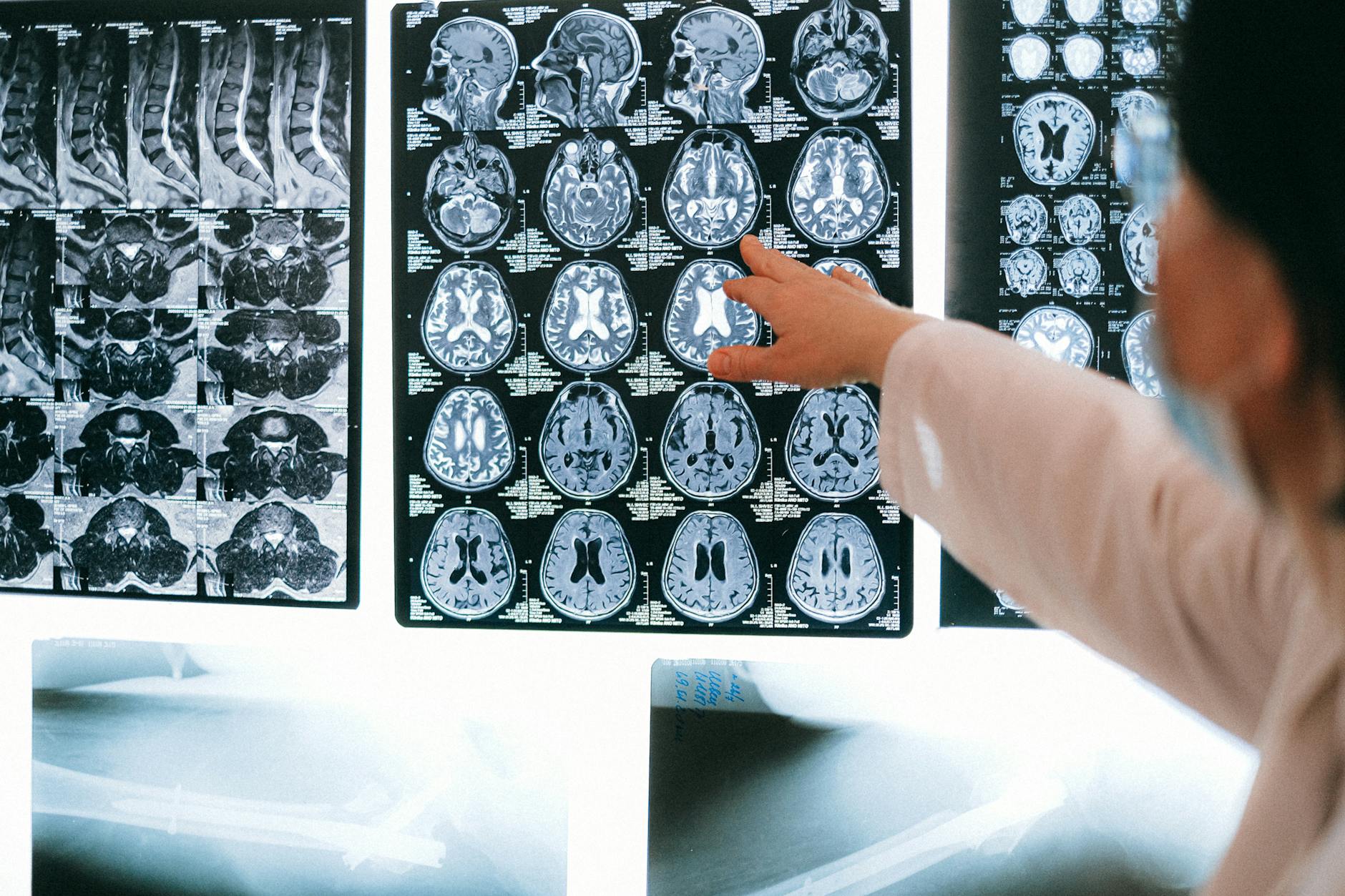 Comparing Preclinical and Clinical Alzheimer's Detection