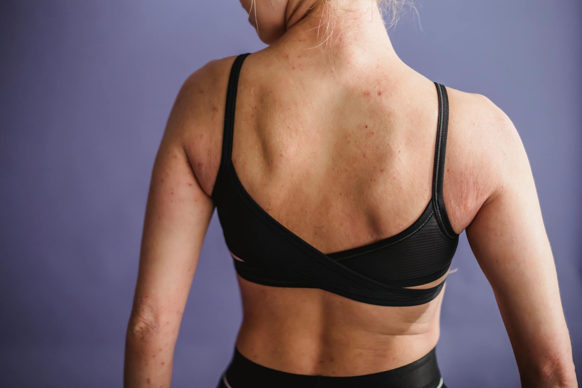 How Common Are Pustules and Who Is Most Likely to Develop Them?