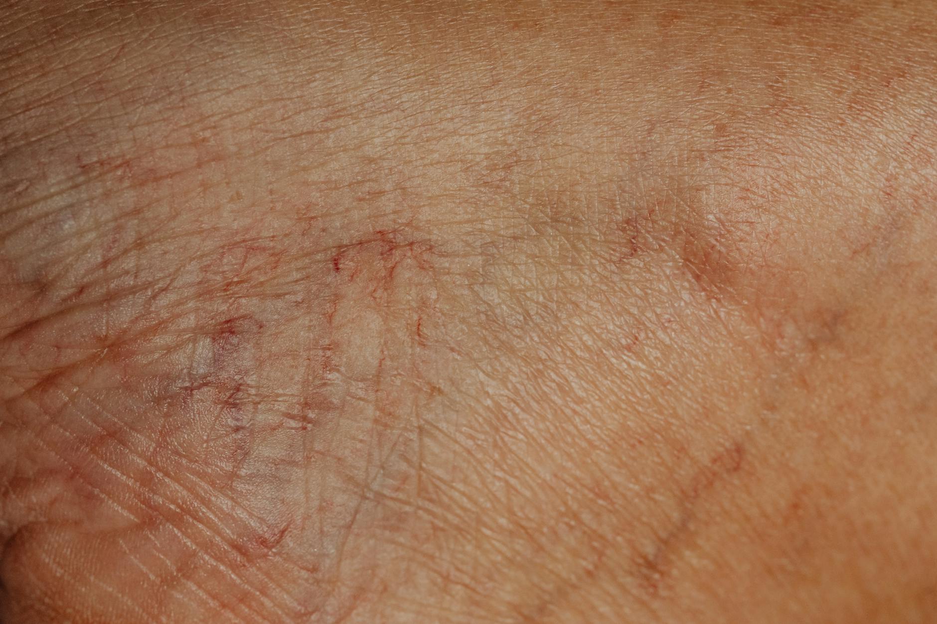 Litifilimab and the Unmet Need in Cutaneous Lupus