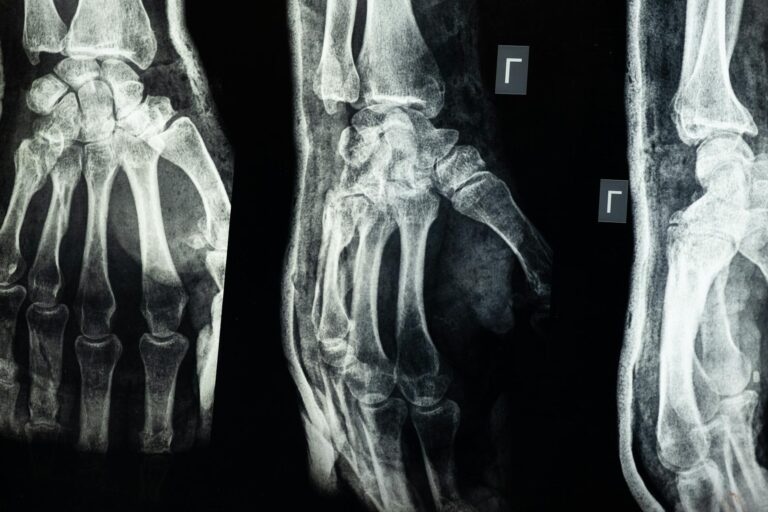 Prolia Injection for Bone Loss: The Results Are Impressive — But There's a Catch - Featured image