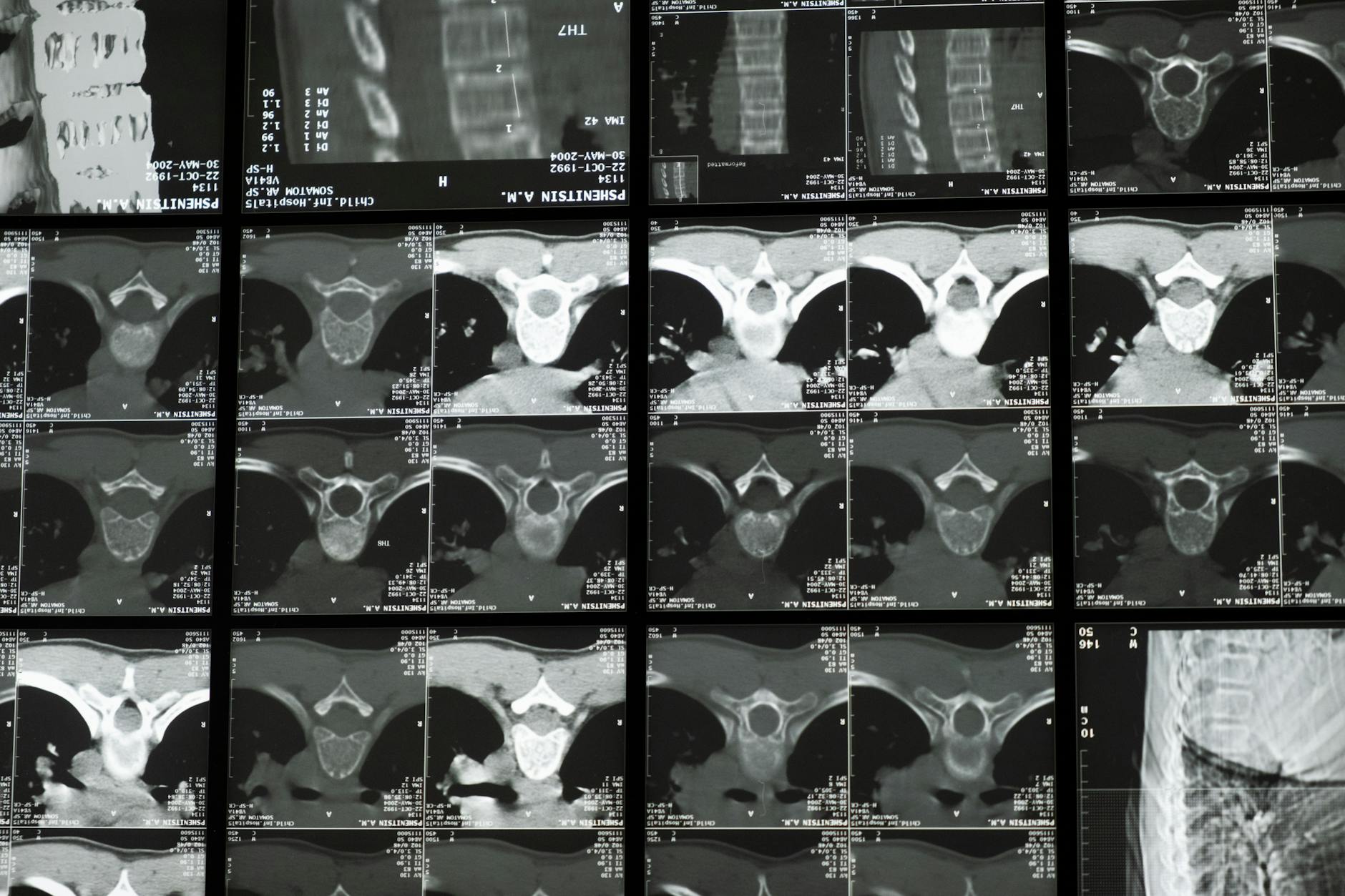 Scoliosis and Secondary Cascades of Degeneration