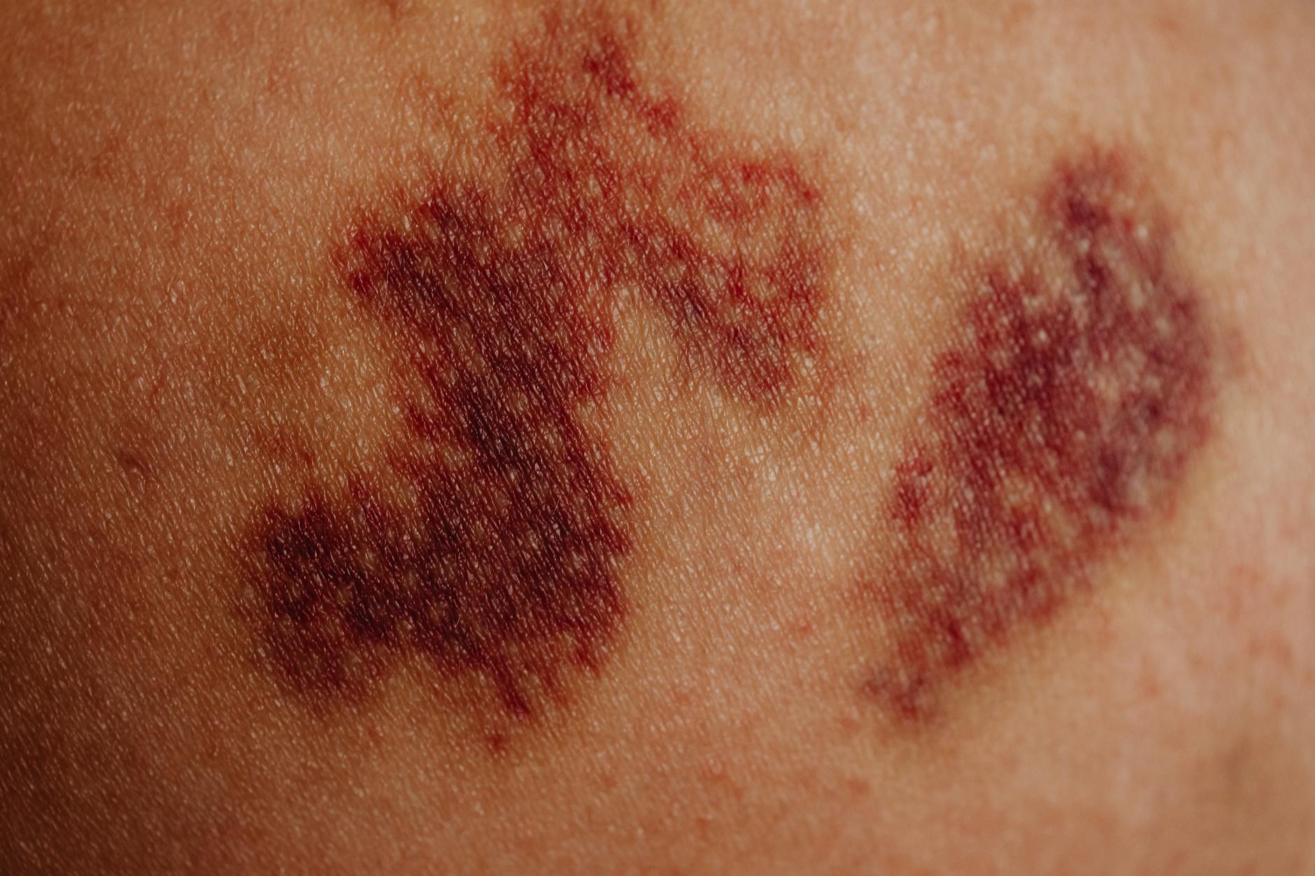 Trauma and Acute Injury as SI Joint Pain Triggers