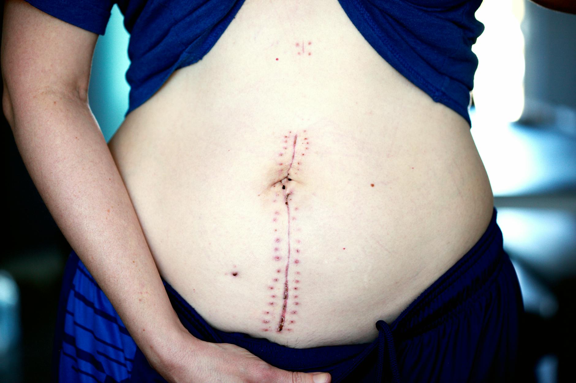 What Boxcar Scars Look Like and Why They're Named That Way