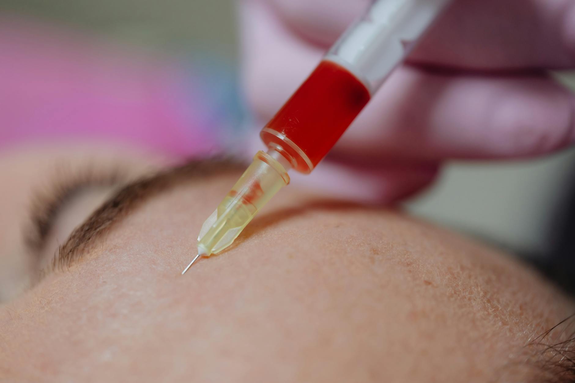 What Does Hormonal Therapy Actually Do for Acne?