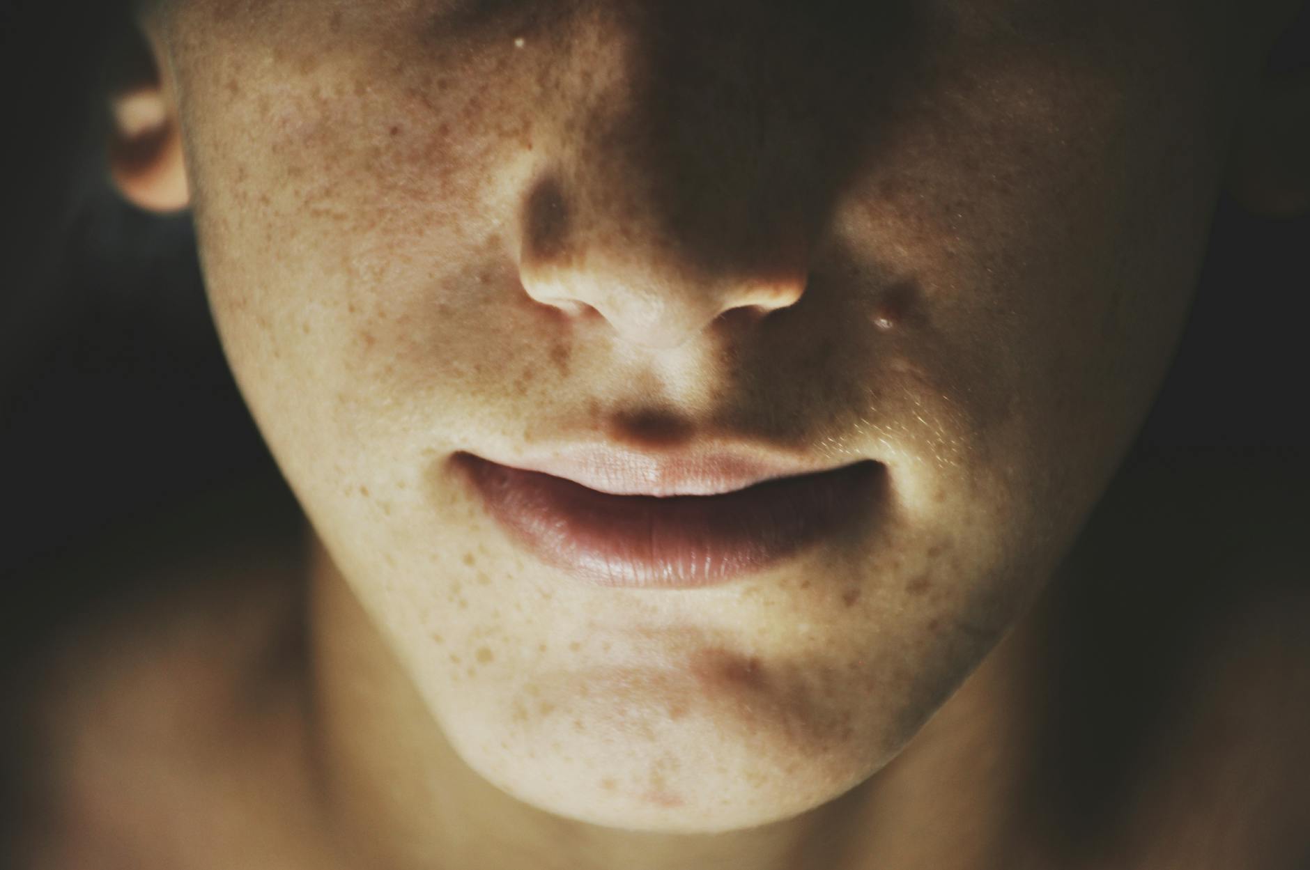 What Is Melasma and How Does It Appear?