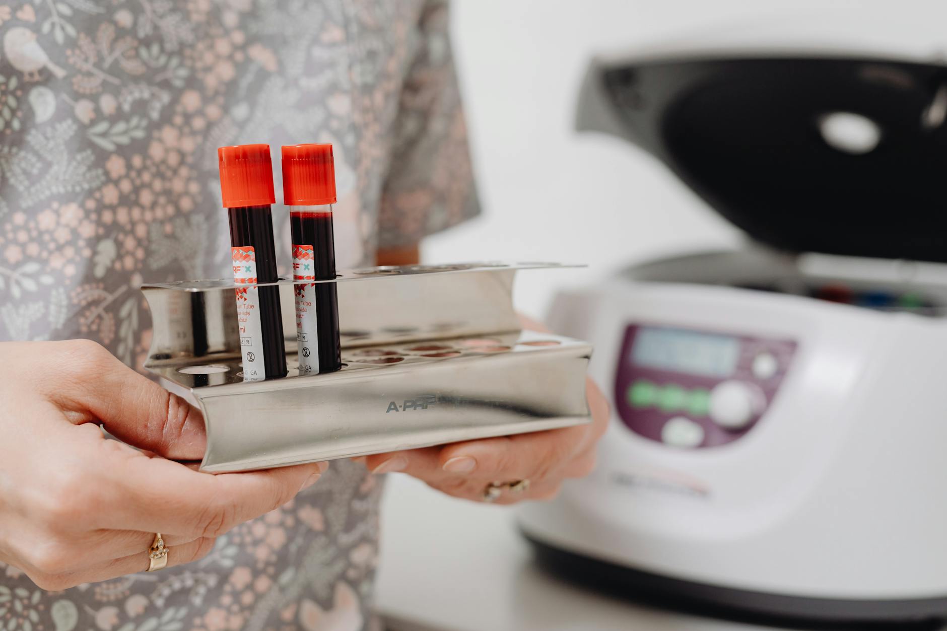 What Makes Blood Tests the Breakthrough in Brain Scanning Accessibility?