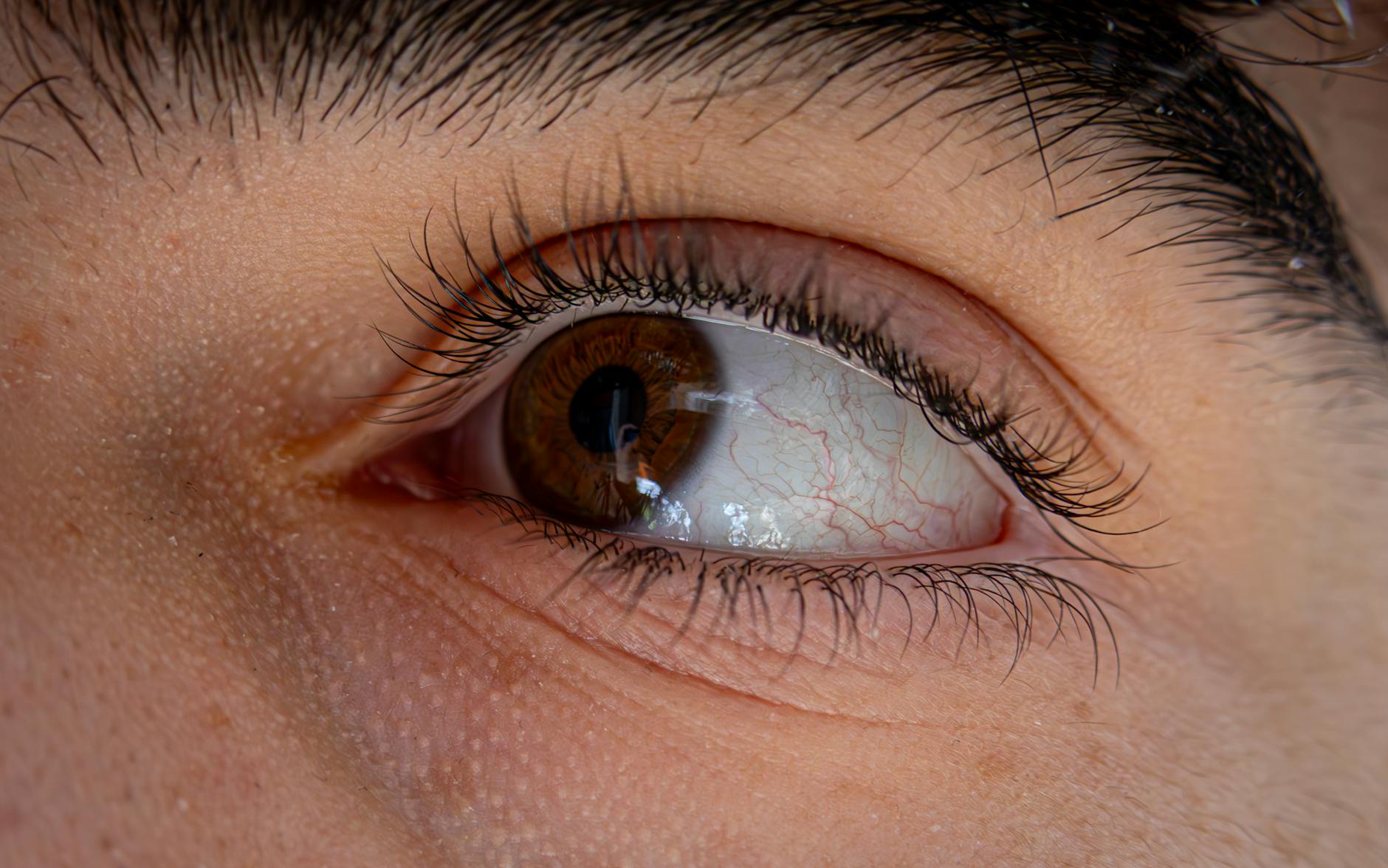 When Does a Degenerating Disc Cause Nerve Problems?