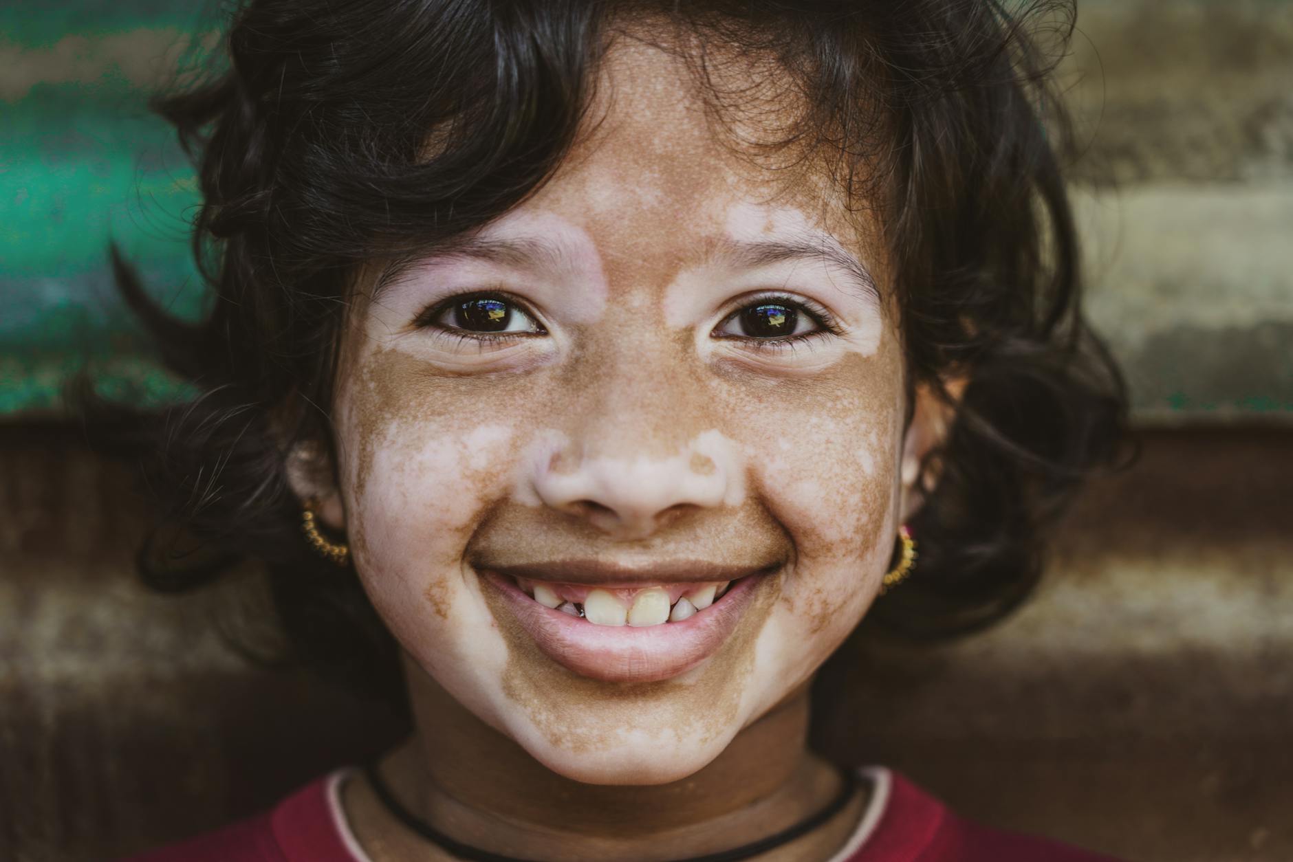 Who Is Most Likely to Develop Melasma?