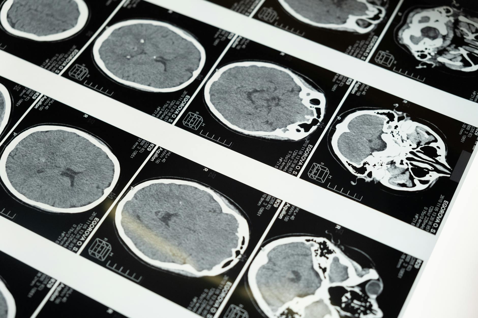 HOW DIET SPECIFICALLY INFLUENCES BRAIN AGING TRAJECTORIES