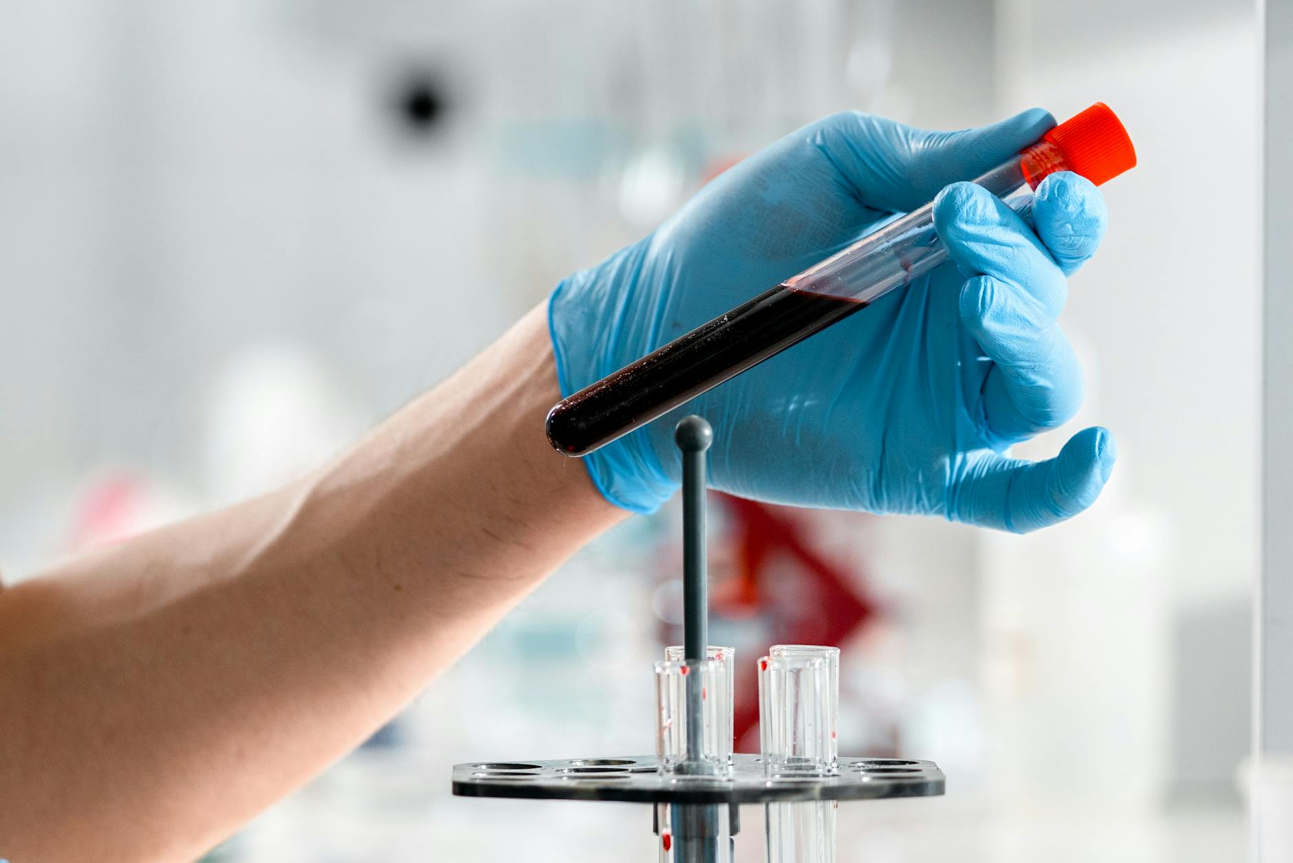 What Blood Tests Can Now Detect in Early Alzheimer's