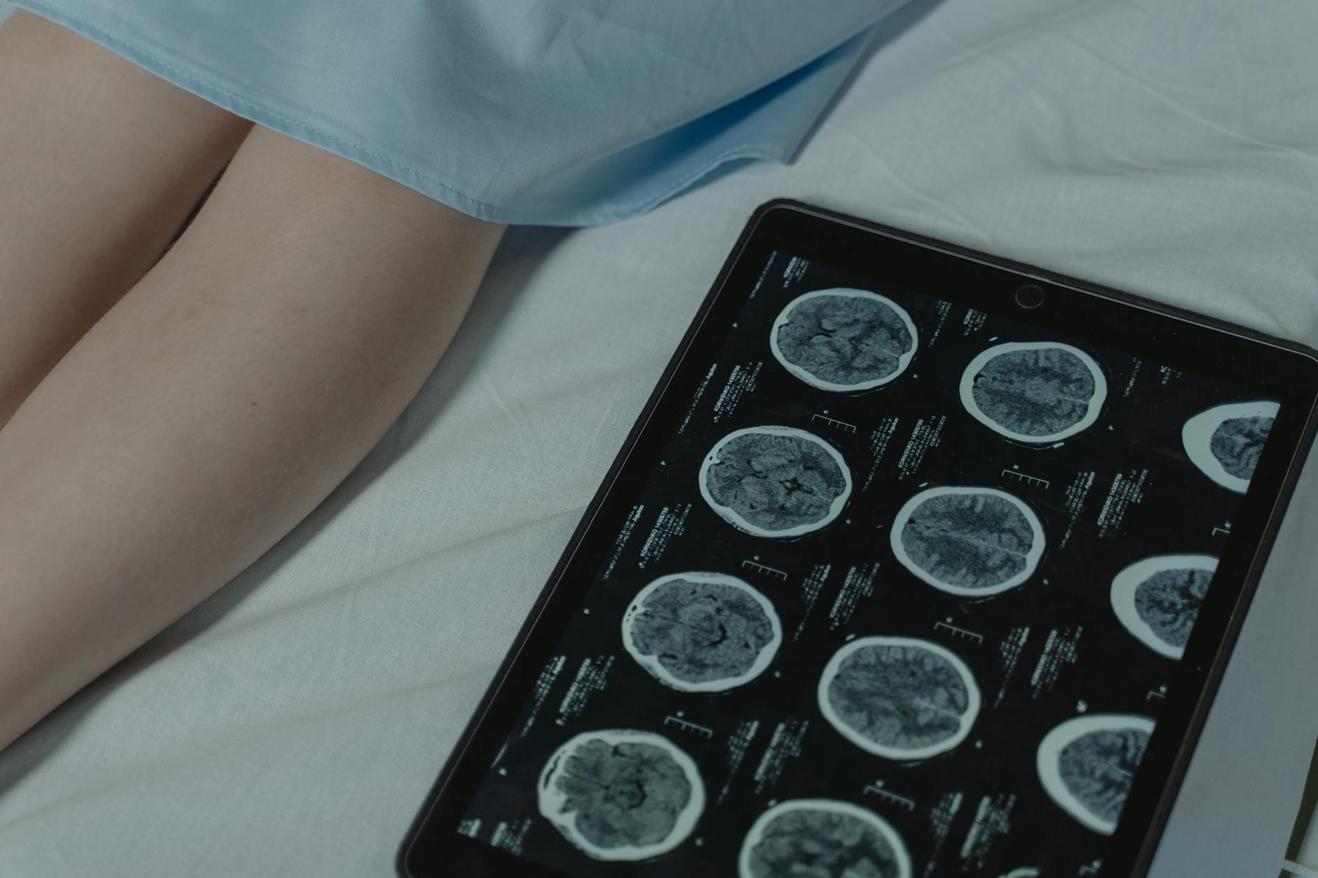 How Encephalomalacia Appears on Brain MRI