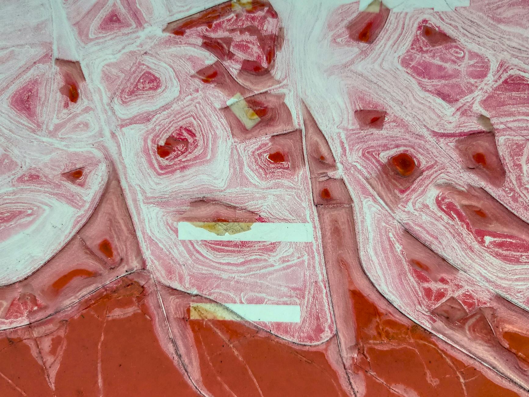What Is Microangiopathy and How Does It Damage the Brain?
