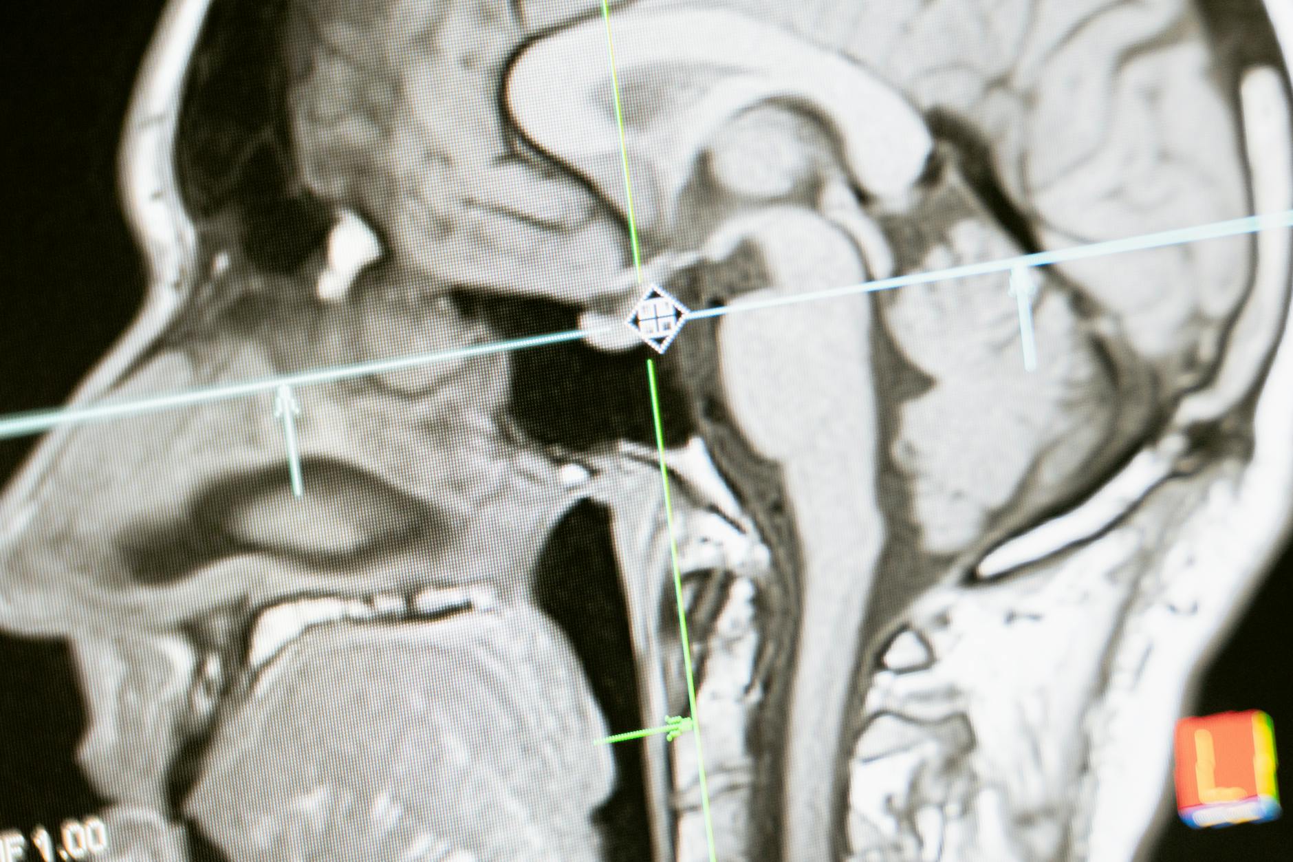 Which Types of Dementia Follow Brain Injury?