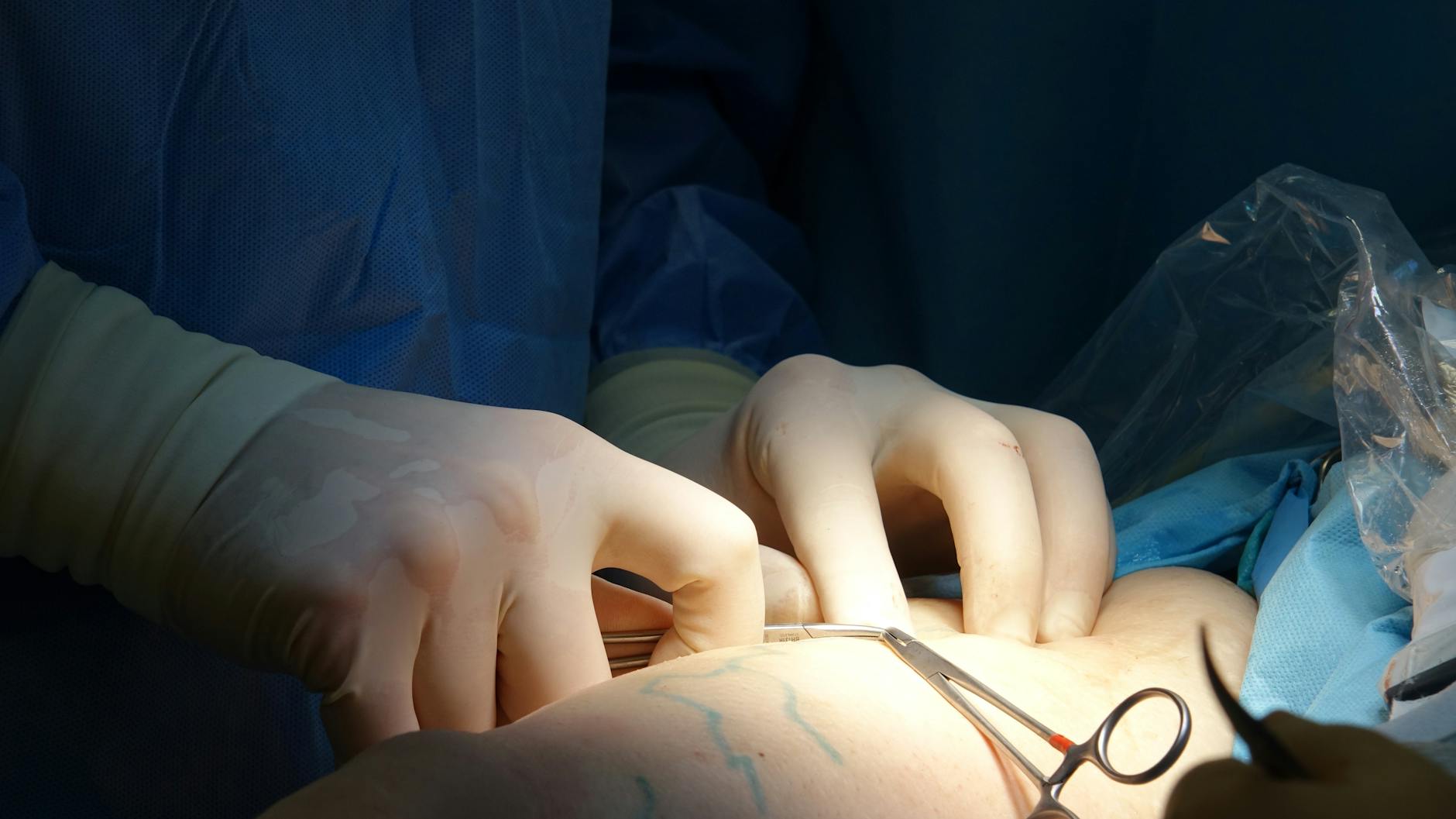 Why Does Surgery Specifically Increase Delirium Risk in Aging Brains?