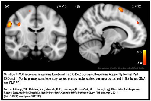 How Trauma Exposure Accelerates Brain Aging