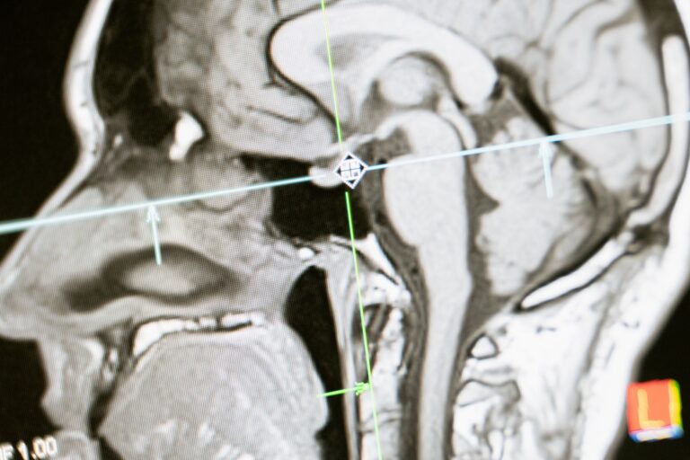 Brain Imaging in Normal Aging vs. Dementia: What Scans Can Show - Featured image