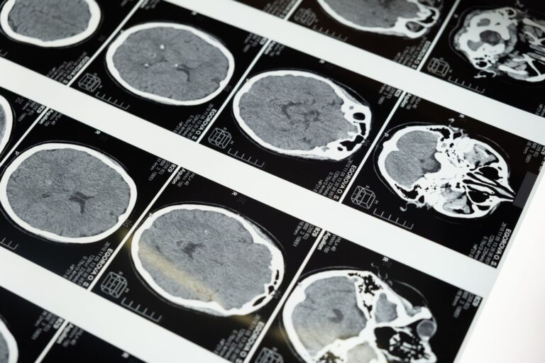 What Brain Scans of Young Adults in Highly Polluted Cities Tell Us About Alzheimer's - Featured image