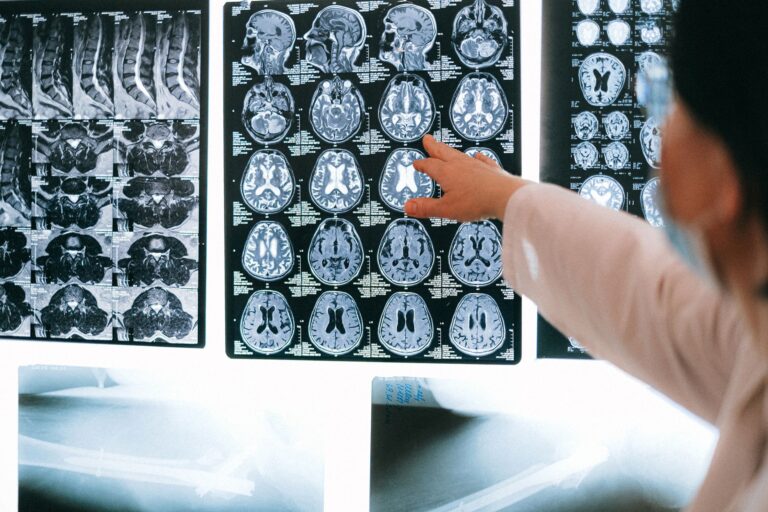 What Can a Brain MRI Show in Alzheimer's and Other Dementias? - Featured image